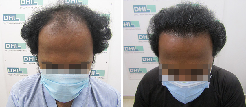 DHI before & after hair transplant results